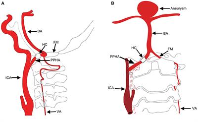 Case Report: Persistent Primitive Hypoglossal Artery Accompanied by a Basilar Bifurcation Aneurysm Treated by Y-Stent-Assisted Coil Embolization